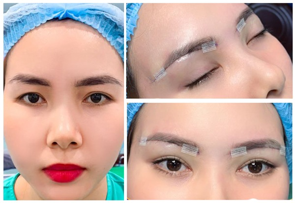 Treo cung mày có để lại sẹo không?