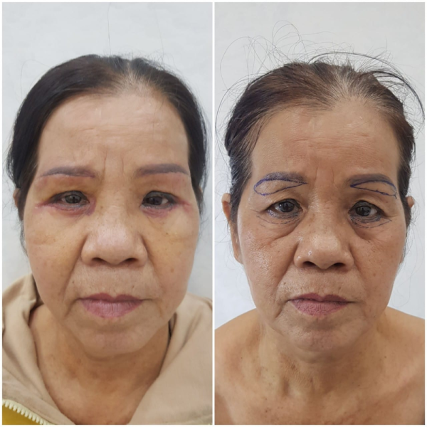 Treo cung mày là gì?