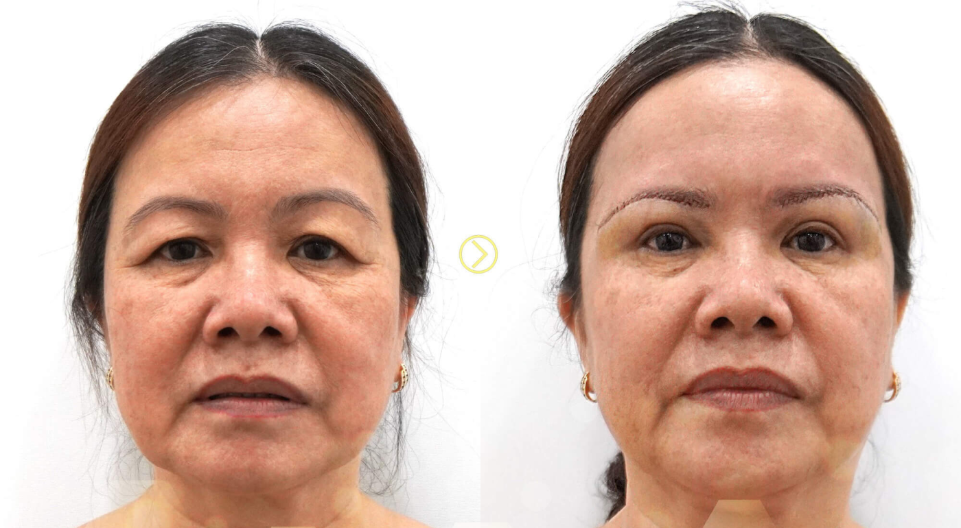 Lưu ý trước và sau khi thực hiện