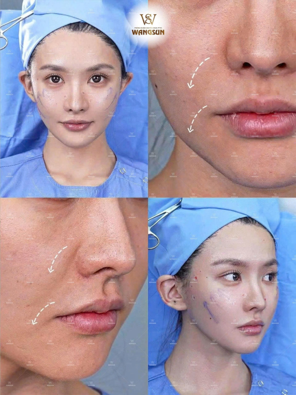 Thực Hư Công Nghệ Căng Da Giấu Chỉ SMAS Có Làm Mặt Trẻ Lại 10 Tuổi Như Lời Đồn? Vì sao công nghệ căng chỉ SMAS được đánh giá cao?
