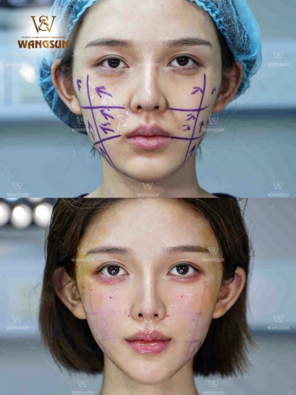 Người từng tiêm filler, botox có thực hiện căng chỉ SMAS được không?