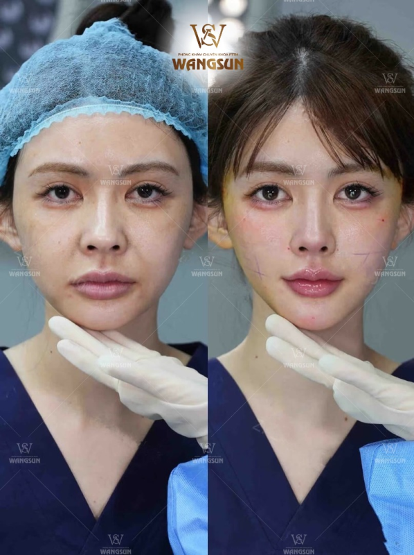 Căng Da Giấu Chỉ SMAS – Giải Pháp Được Khuyến Nghị Cho Người Lão Hóa Tuổi 30+ Đối tượng phù hợp để căng chỉ SMAS
