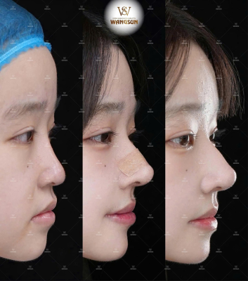thu gọn cánh mũi 3d ultra