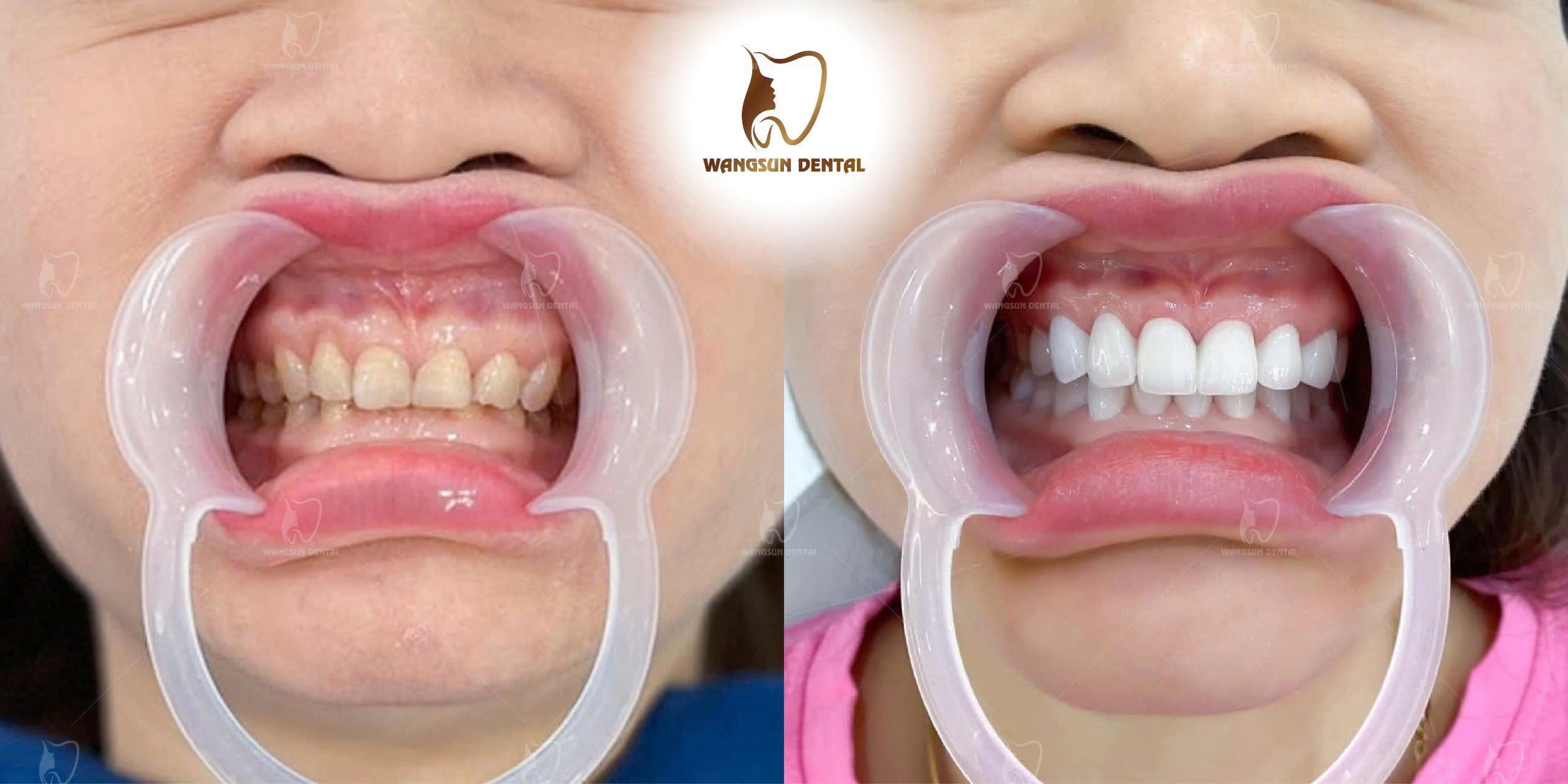 Răng Sứ Có Bền Không? Sự Thật Nhiều Người Làm Răng Chưa Biết Yếu tố nào quyết định độ bền của răng sứ?