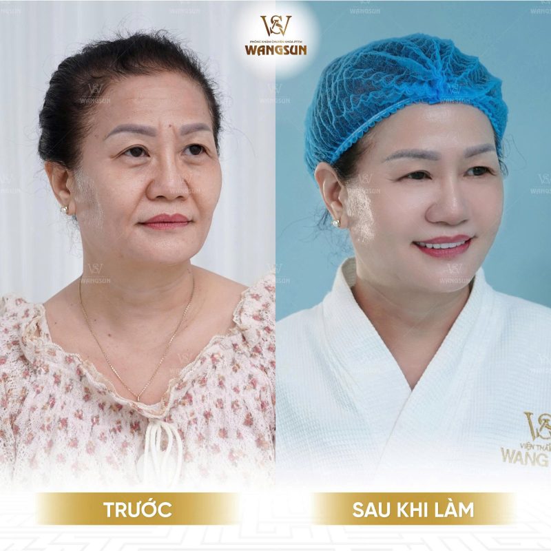 WangSun Diamond DNA Plus - Giải pháp cải thiện da chùng nhão không phẫu thuật