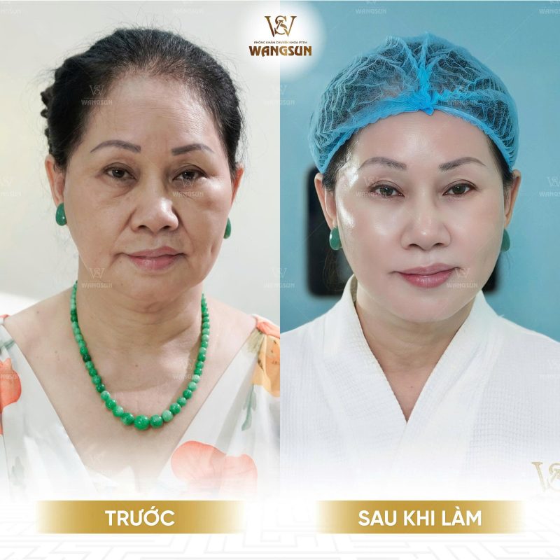 Căng Da Giấu Chỉ SMAS Là Gì?
