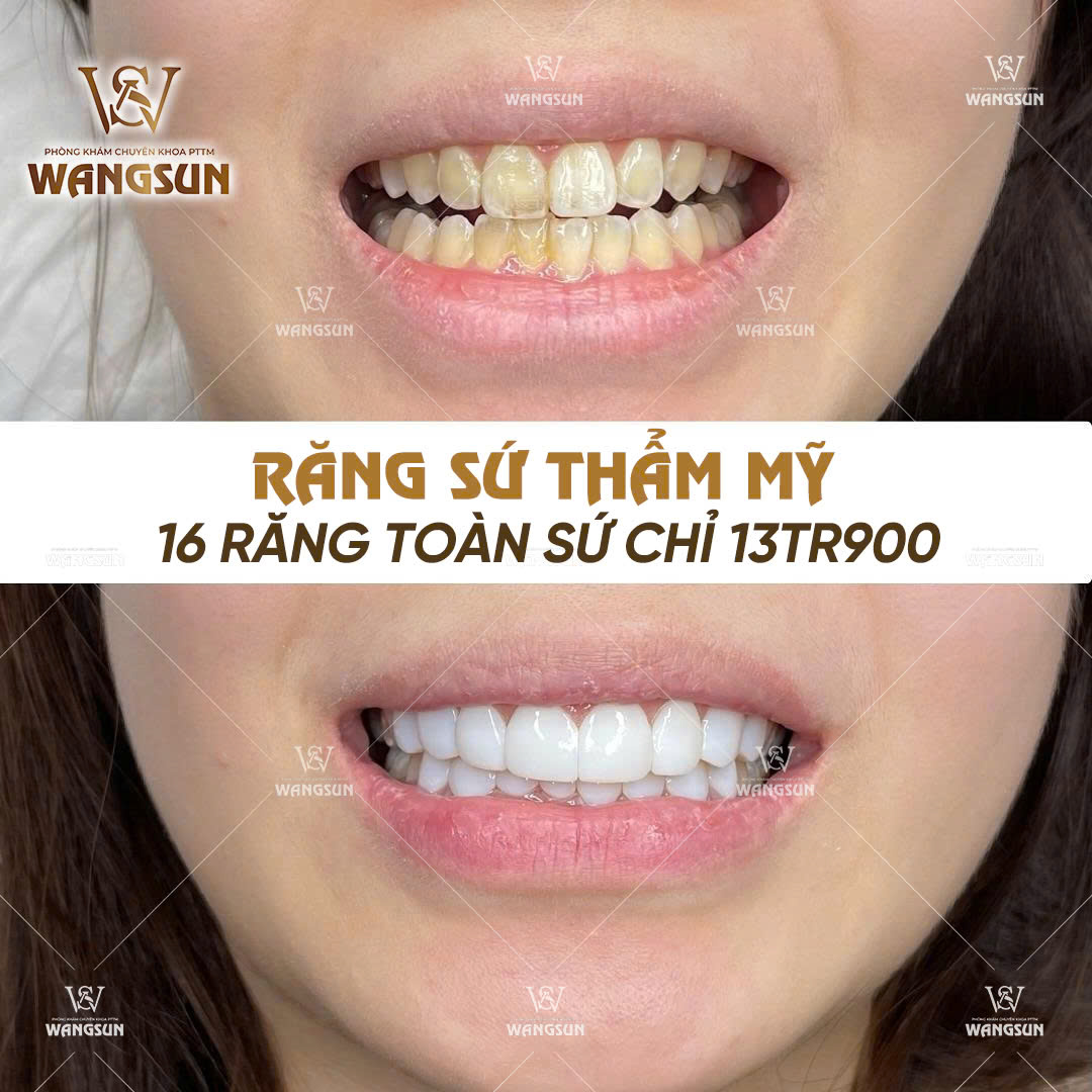 Răng Sứ Có Bền Không? Sự Thật Nhiều Người Làm Răng Chưa Biết Làm sao để răng sứ bền lâu như mong đợi?