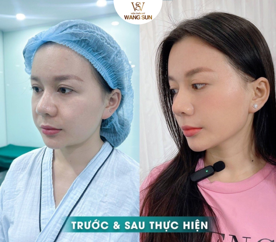 Nâng Cơ Táo WangSun khẳng định vị thế công nghệ trẻ hóa hiện đại Nâng cơ táo