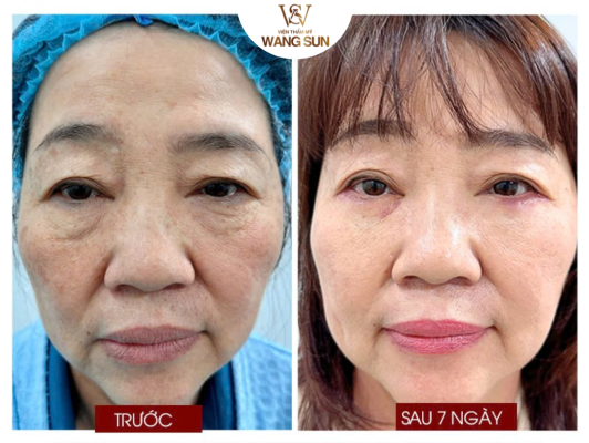 Giá Trẻ Hóa Da Mặt Bao Nhiêu? Bảng Giá & Cách Chọn Liệu Trình Phù Hợp Những yếu tố quyết định giá trẻ hóa da mặt