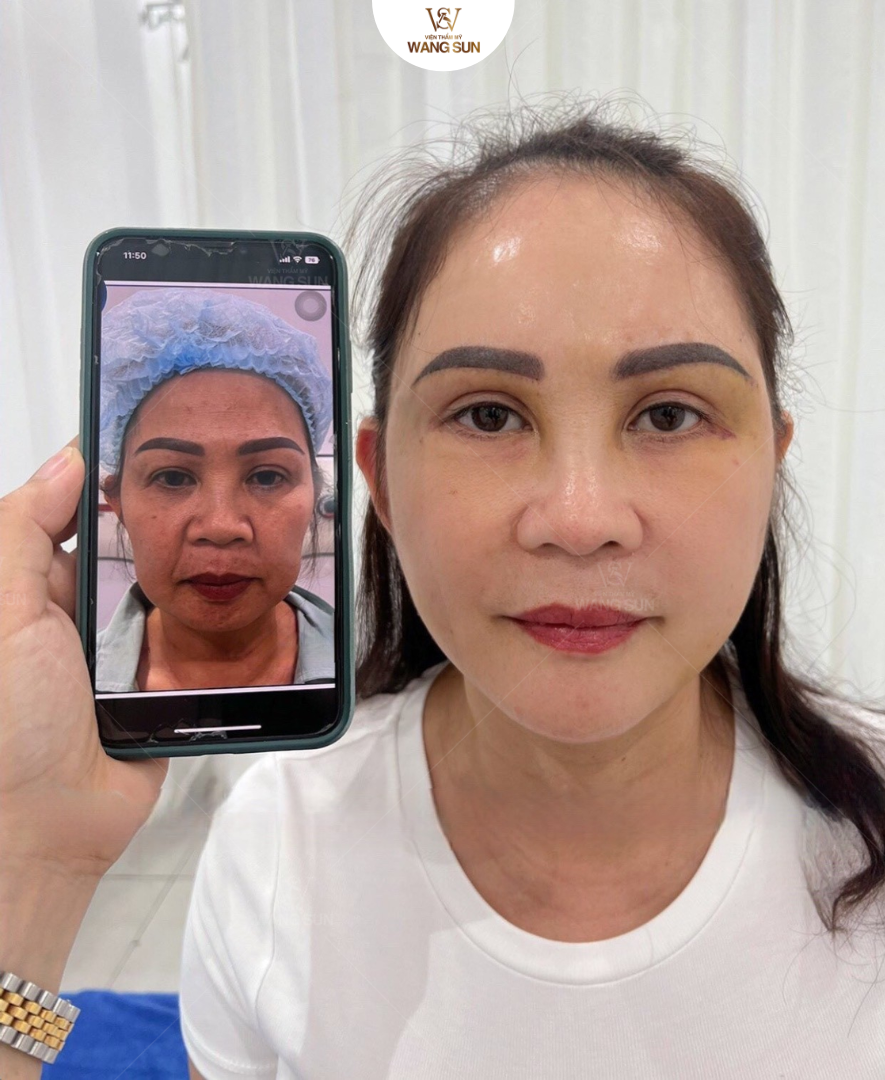 Công nghệ Nâng Cơ Táo có an toàn không, cần lưu ý gì trước khi làm? Lợi ích nổi bật khi dùng Công nghệ Nâng Cơ Táo
