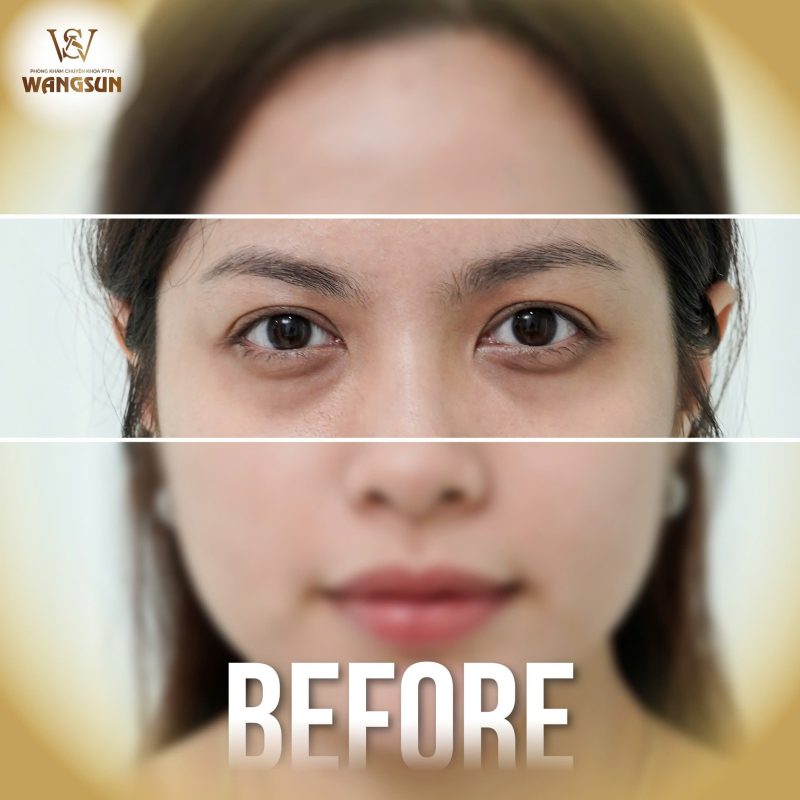 Nếp nhăn đuôi mắt khiến bạn già trước tuổi? WangSun Diamond Eyes giúp bạn lấy lại đôi mắt tươi trẻ, đầy sức sống nhăn đuôi mắt