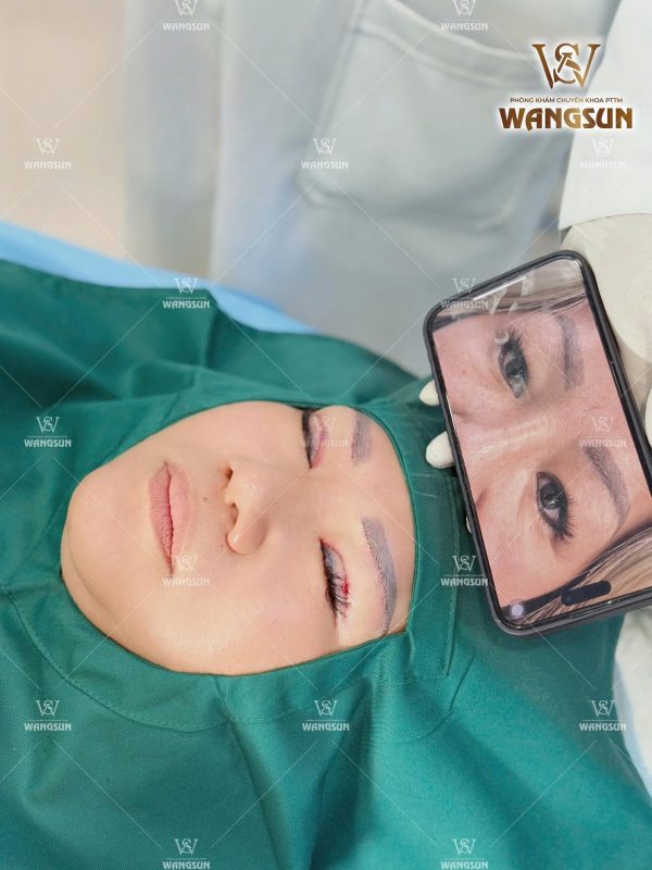 Nâng cung chân mày giấu chỉ