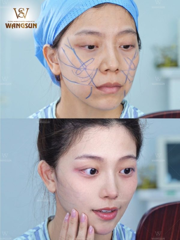 Nâng cơ táo - xu hướng trẻ hóa gò má hot nhất hiện nay Nâng cơ táo - giải pháp trẻ hóa gò má hiện đại