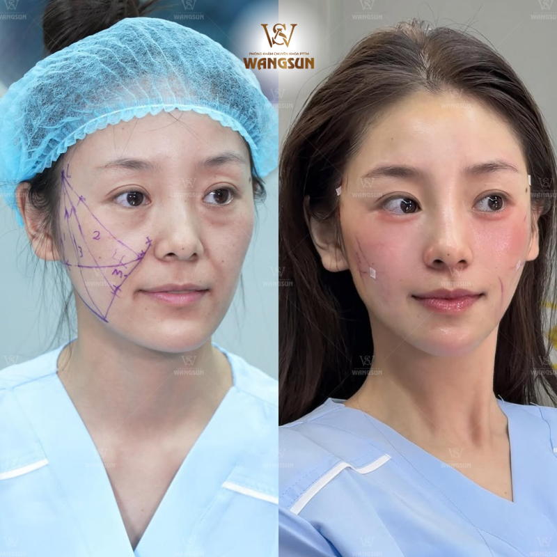 Khách hàng nói gì sau khi trải nghiệm Công nghệ Nâng Cơ Táo? Công nghệ Nâng Cơ Táo