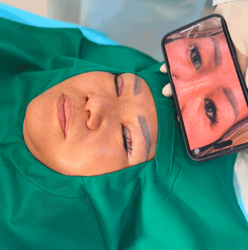 Cắt mí cánh tiên trước sau