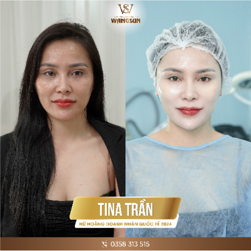 Cảnh Báo Không Nên Lạm Dụng Tiêm Tan Mỡ Khi Đã Có Công Nghệ Cell Face X Pro trước và sau khi làm đẹp