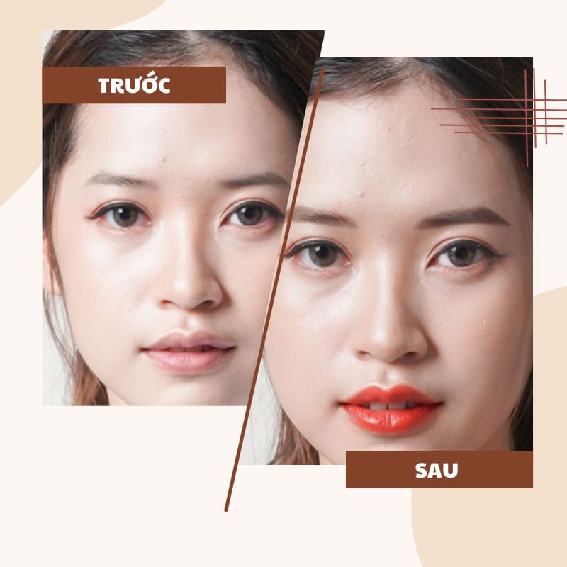 Nhân Trung Nông Là Gì? Nguyên Nhân Và Các Phương Pháp Cải Thiện Hiện Nay cấy ha tạo hình môi