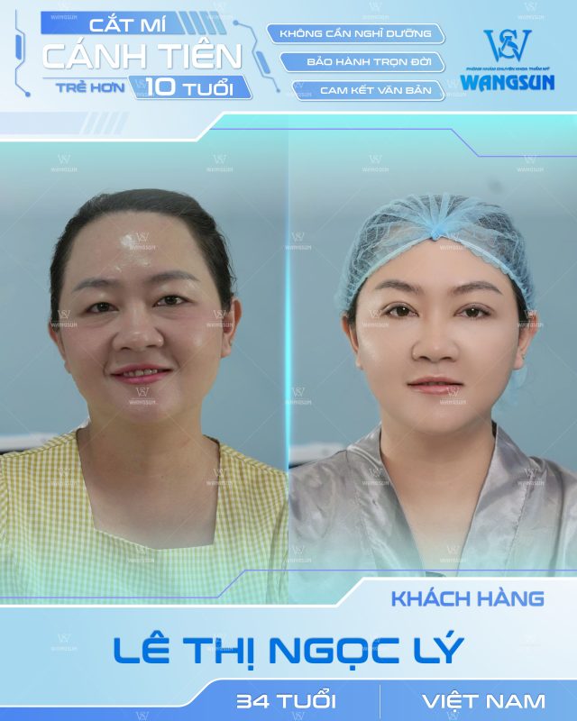cắt mí cánh tiên