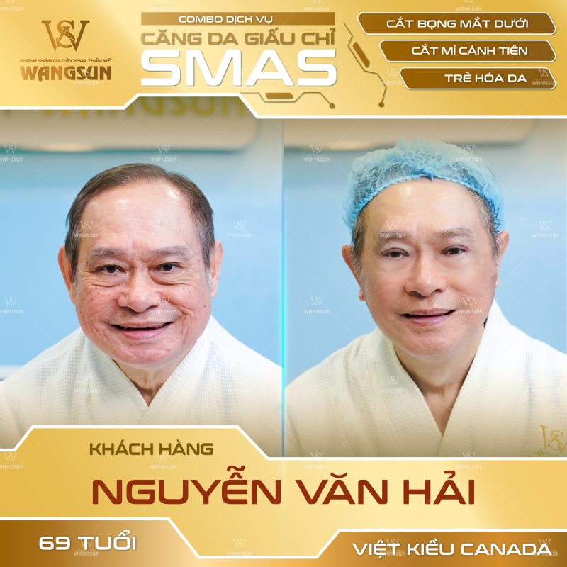 căng da giâu chỉ smas trước sau văn hải