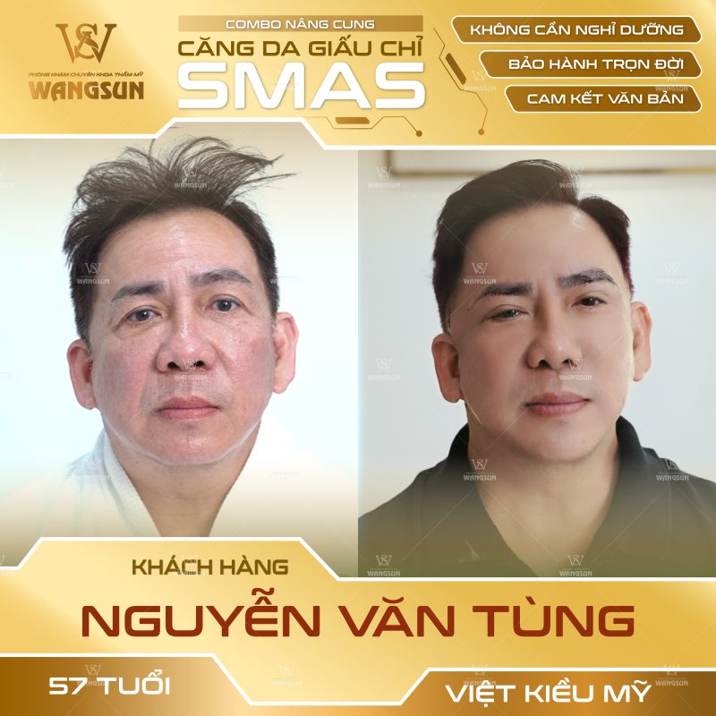 trước sau căng da giấu chỉ smas nguyễn văn tùng