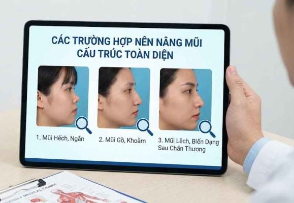 Các trường hợp nên nâng mũi cấu trúc toàn diện