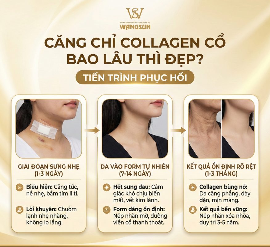 Căng chỉ collagen cổ giữ được bao lâu