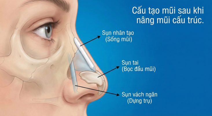 Nâng Mũi Cấu Trúc Có Vĩnh Viễn Không? Giải Đáp Từ Bác Sĩ cấu tạo mũi sau khi nâng mũi cấu trúc