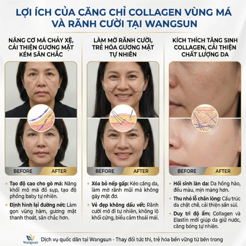 Lợi ích của căng chỉ collagen vùng má rãnh cười