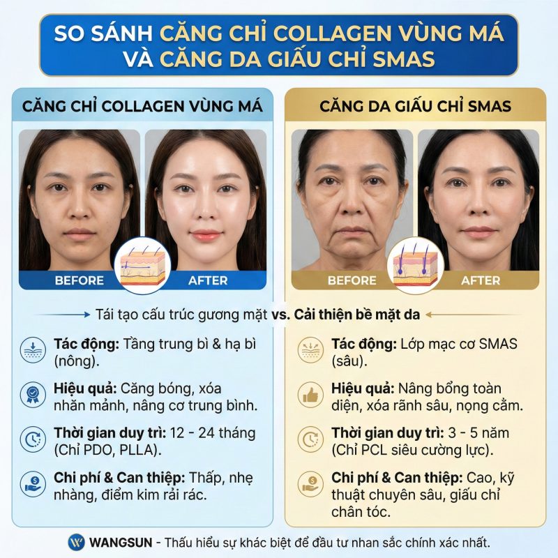 So sánh căng chỉ collagen vùng má và căng da giấu chỉ smas