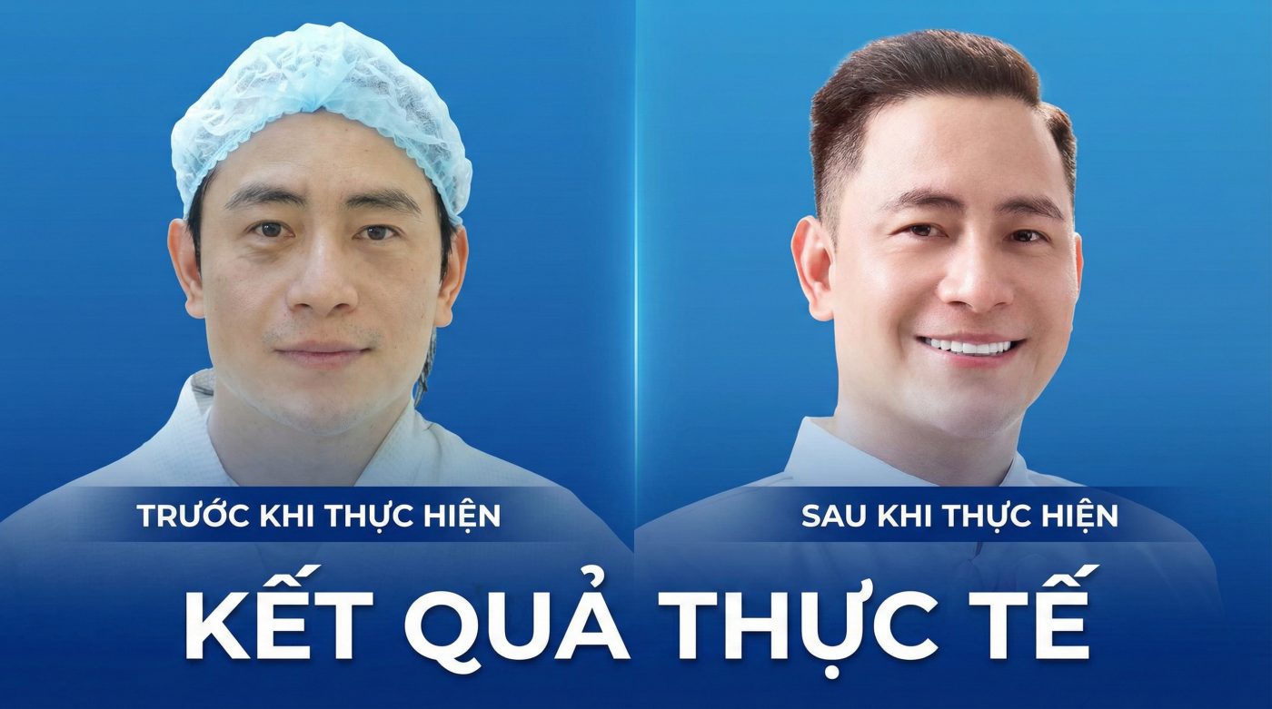 Cấy Collagen Tươi Là Gì? Giải Thích Toàn Diện Từ A–Z (Cập Nhật 2026) Trước sau thực hiện cấy collagen tươi
