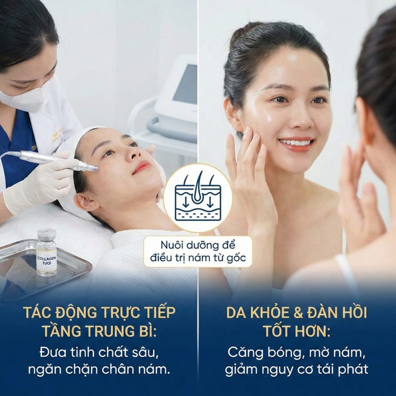 Vì sao cấy collagen tươi xóa nám hiệu quả