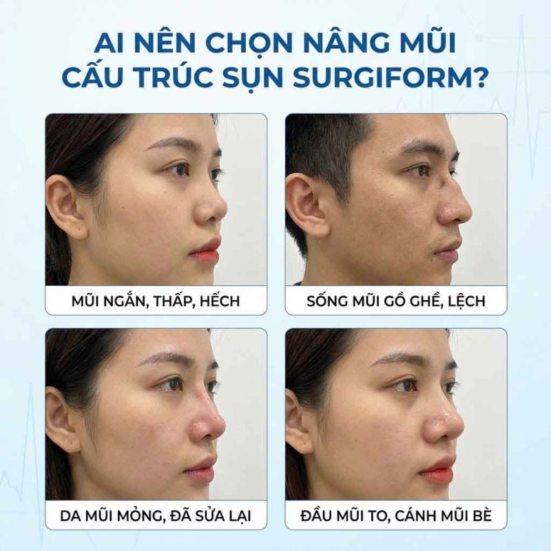 Nâng mũi cấu trúc sụn Surgiform là gì? Ưu điểm & độ bền Ai nên nâng mũi cấu trúc sụn Surgiform
