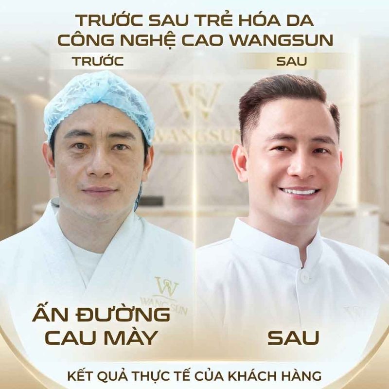 Tiêm BAP Karisma Có Tốt Không? Phân Tích Chuyên Sâu Trước sau trẻ hóa sa công nghệ cao