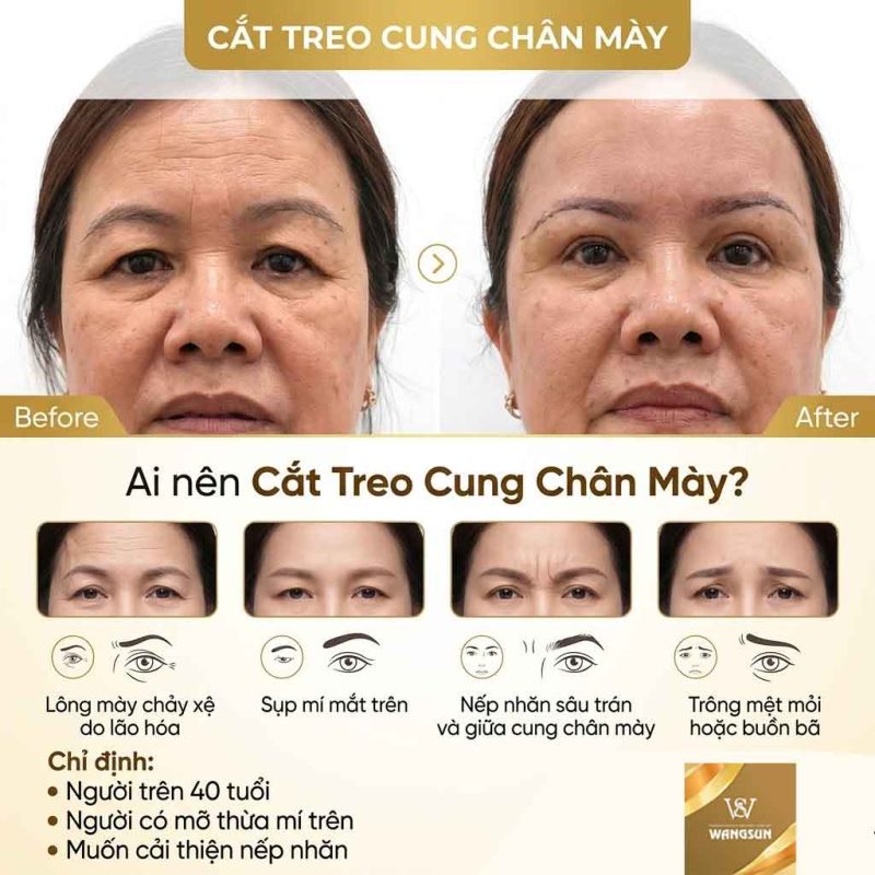 Top 7 Công Nghệ Và Phương Pháp Khắc Phục Đôi Mắt Buồn Được Quan Tâm Hiện Nay Ai nên cắt treo cung chân mày