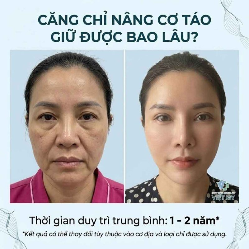 Căng chỉ nâng cơ táo giữ được bao lâu?