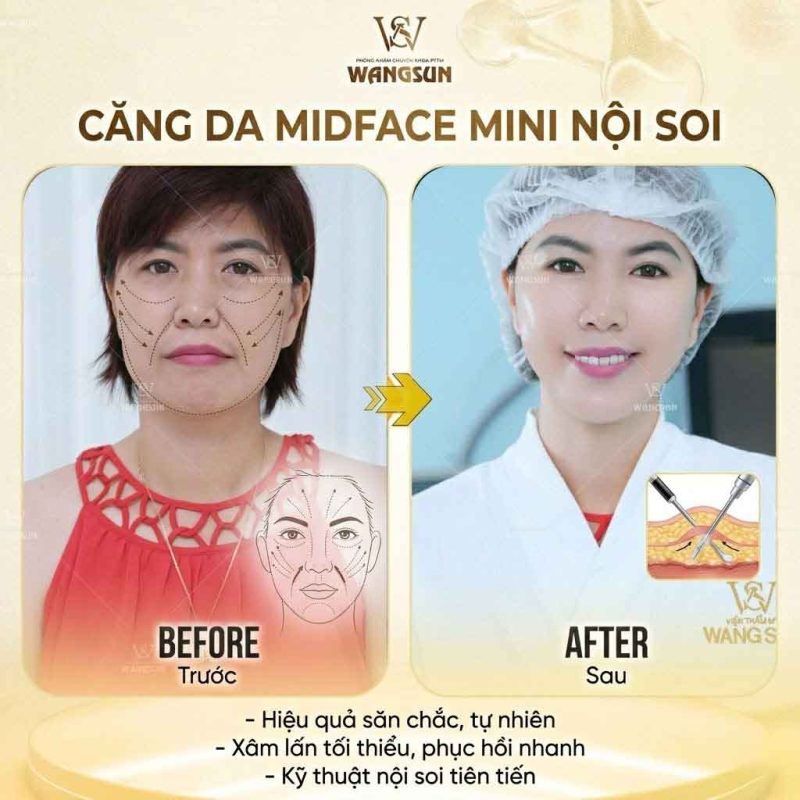 Căng Da Midface Mini Nội Soi