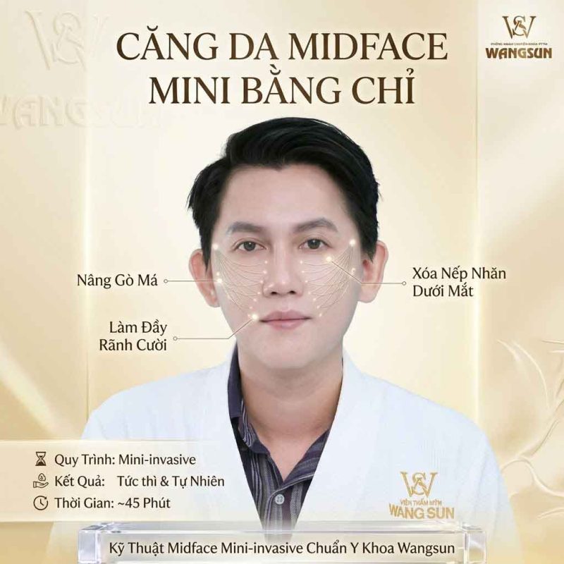 Căng da mặt midface bằng chỉ