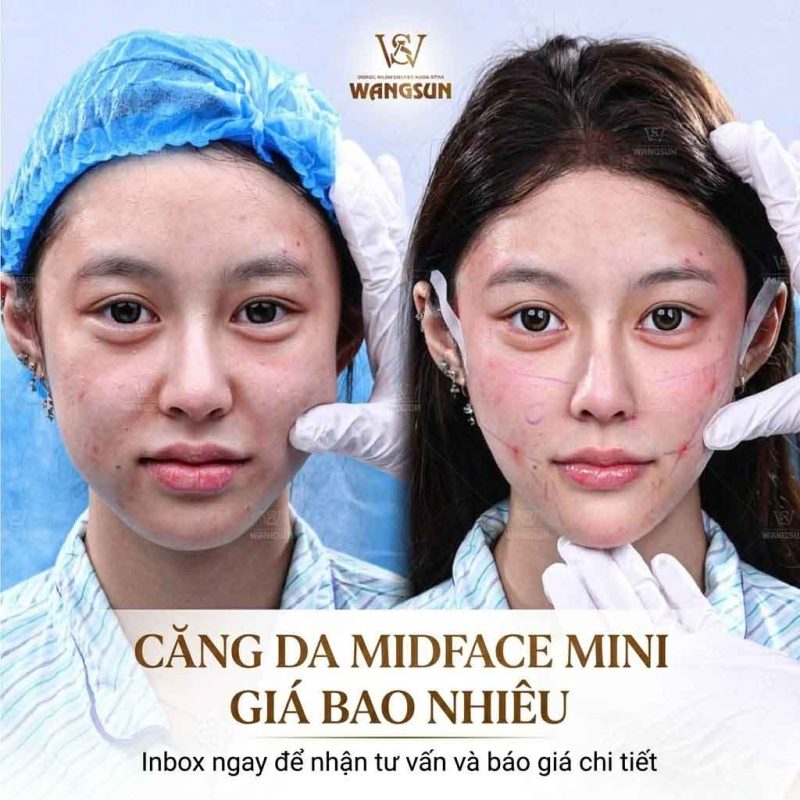 Căng da midface mini giá bao nhiêu?