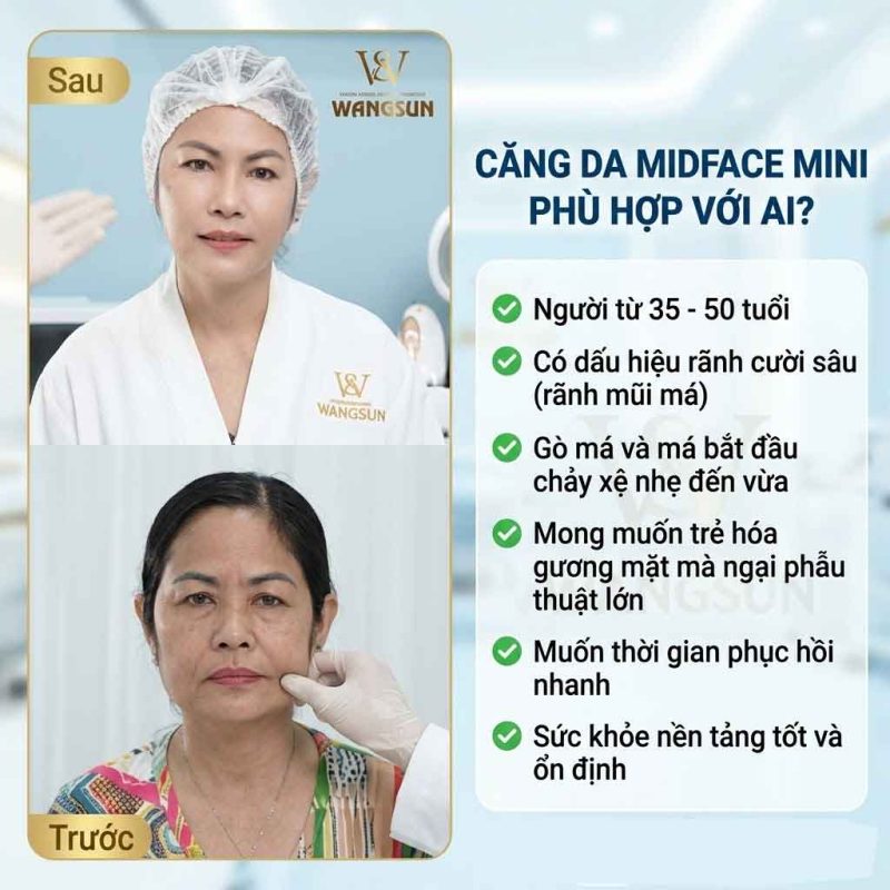 Căng da midface mini phù hợp với ai?