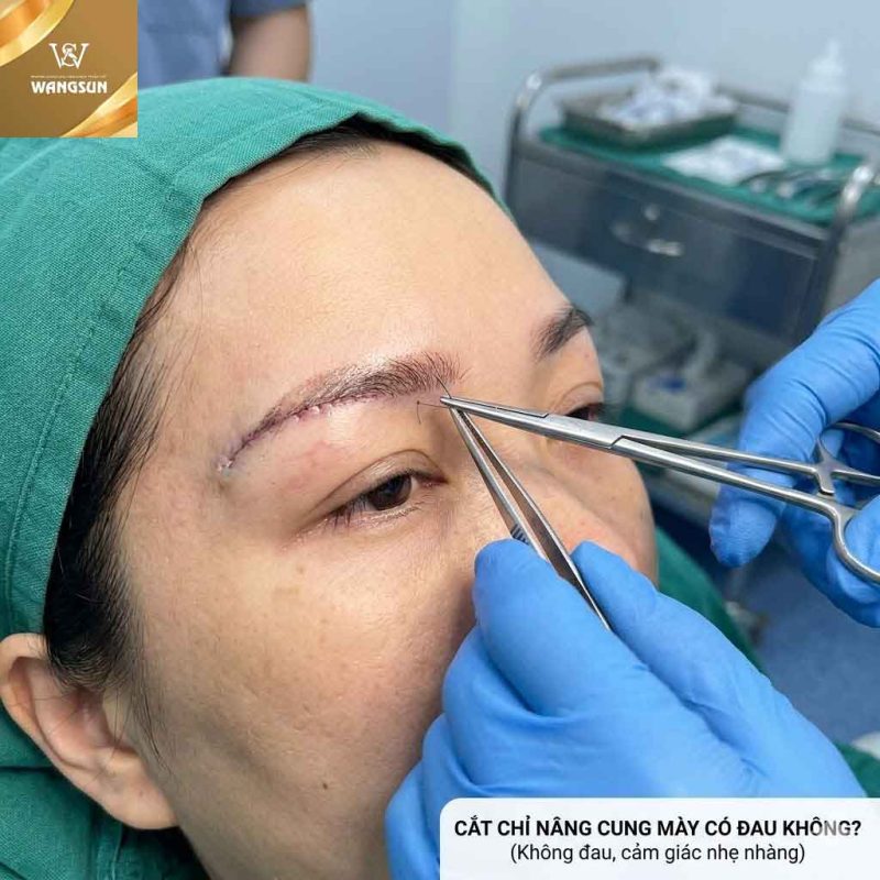 Cắt chỉ nâng cung mày có đau không