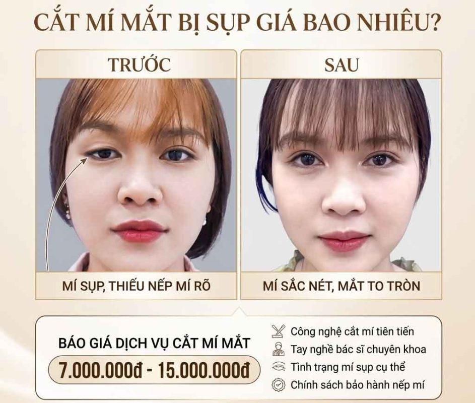 Cắt mí mắt bị sụp giá bao nhiêu