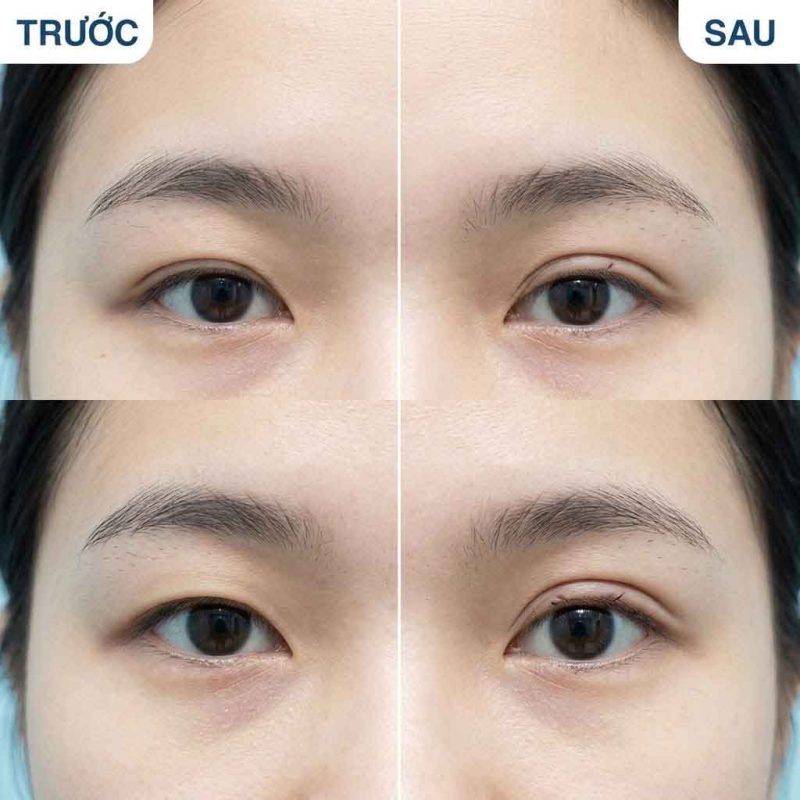 Cách Cắt Mí Mini Deep: Quy Trình Thực Hiện Chuẩn Y Khoa