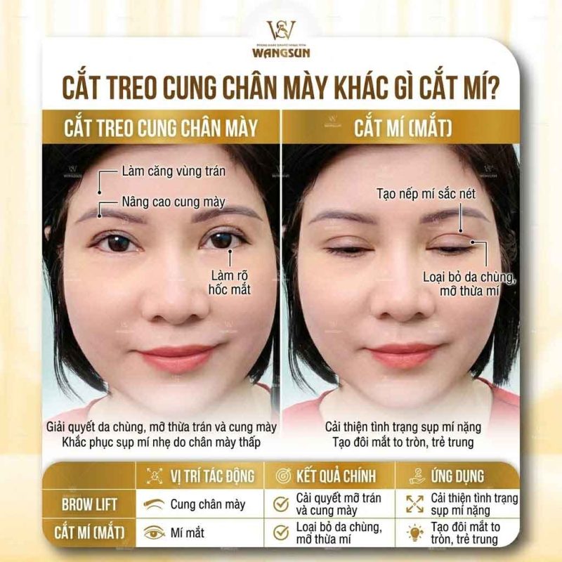 Cắt treo cung chân mày khác gì cắt mí