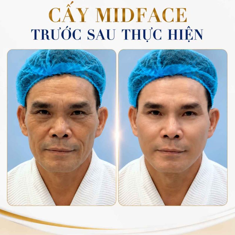Cấy Midface Có Làm Cao Gò Má Không? Giải Đáp Sự Thật Bạn Cần Biết Cấy midface trước sau thực hiện