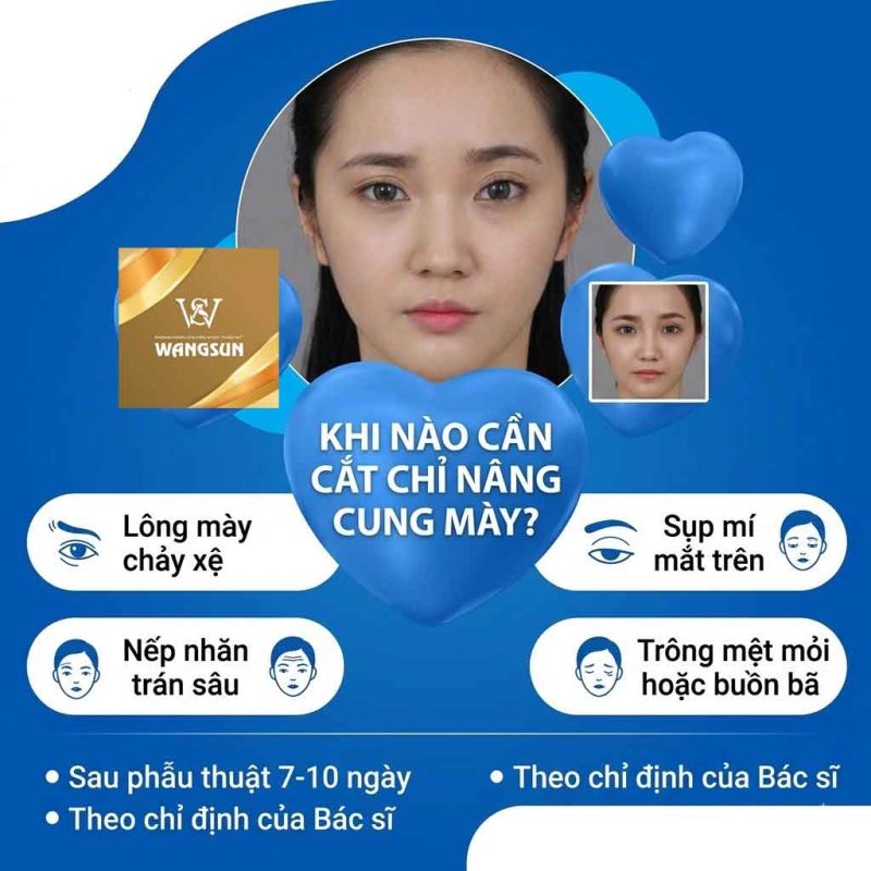 Khi nào cần cắt chỉ nâng cung mày