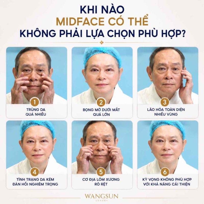 Midface Làm Đầy Trũng Mắt Là Gì? Giải Pháp Trẻ Hóa Vùng Dưới Mắt Hiệu Quả Khi nào midface không còn là lựa chọn phù hợp