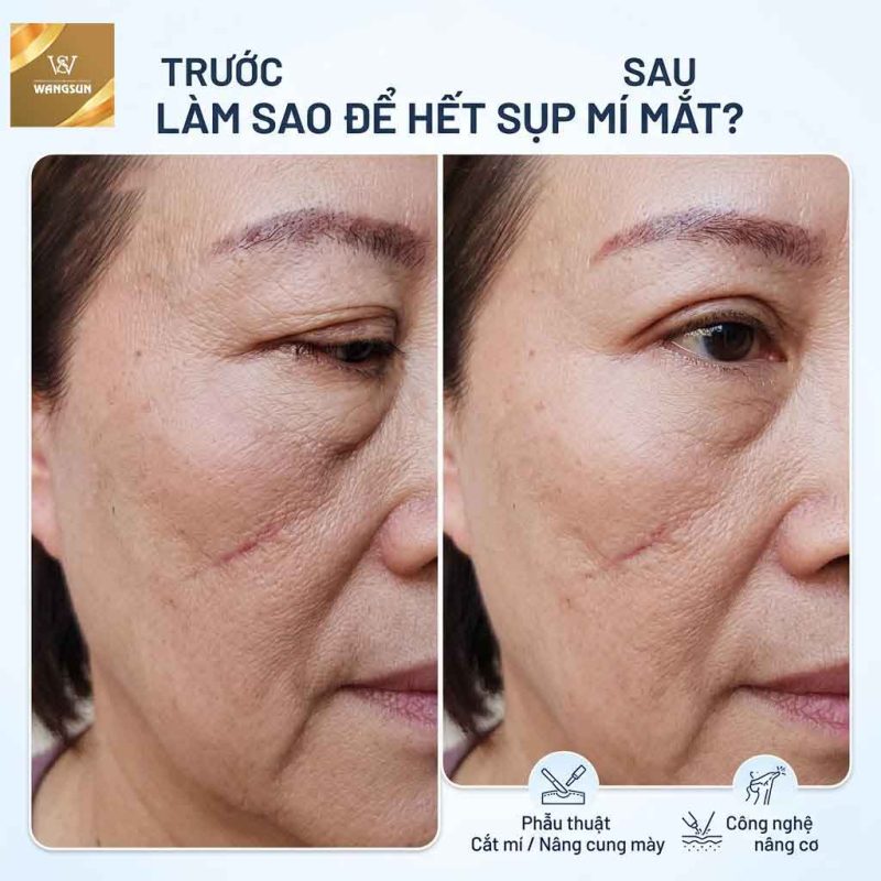 Làm sao để hết sụp mí mắt