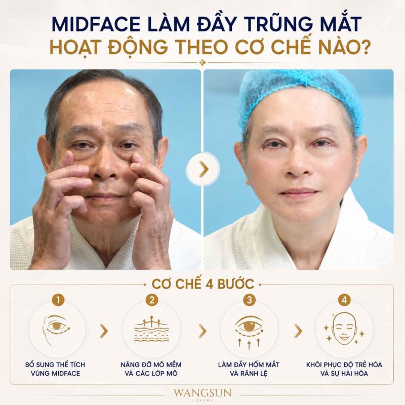 Midface Làm Đầy Trũng Mắt Là Gì? Giải Pháp Trẻ Hóa Vùng Dưới Mắt Hiệu Quả Midface làm đầy trũng mắt hoạt động theo cơ chế nào