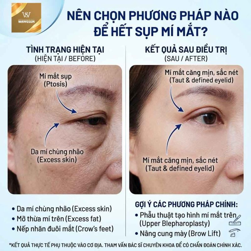 Nên chọn phương pháp nào để hết sụp mí mắt