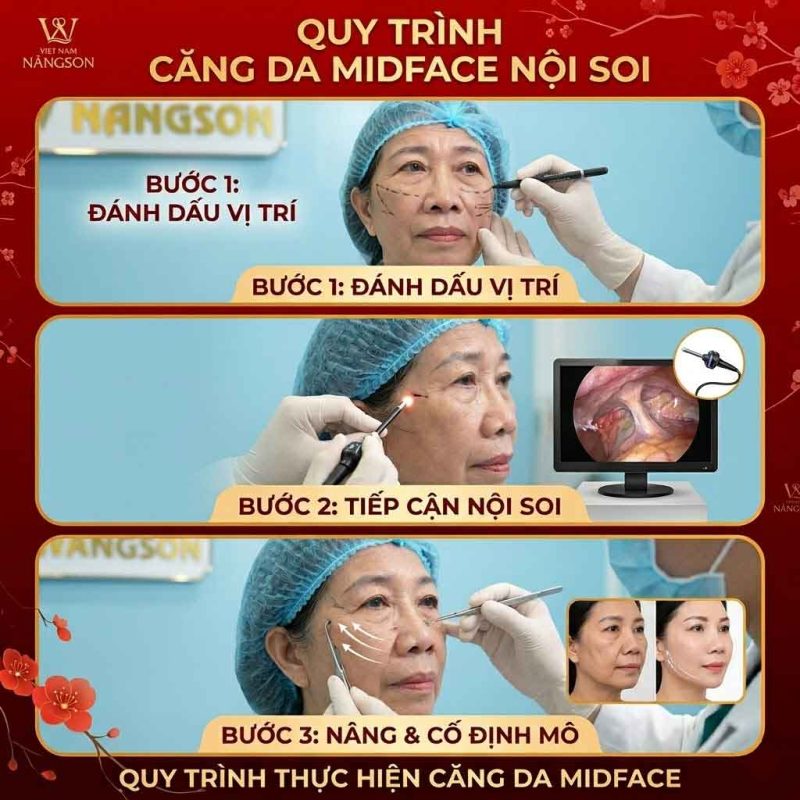 Quy trình căng da midface nội soi